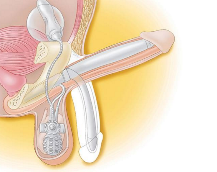 Implante de pene de tres piezas